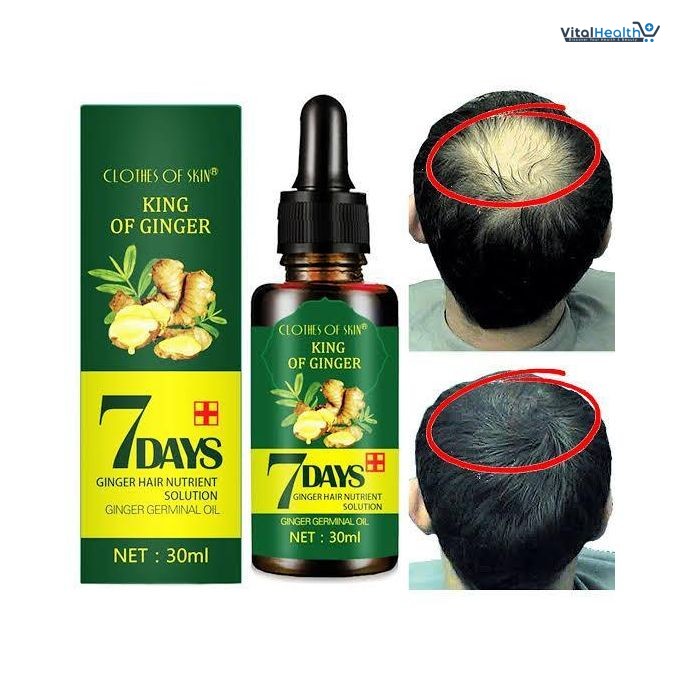 EELHOE King of Ginger 7 Days Ginger Germinal Hair Spray For Damaged Scalp Treatment and Hair Loss thumbnail 3