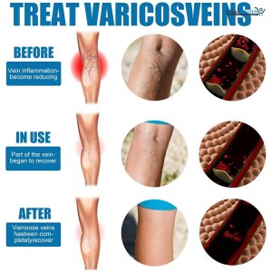 South Moon Varicose Veins Treatment Spray – 30ml Advanced Formula for Spider Veins, Leg Pain &amp; Swelling Relief | Natural Herbal Spray for Better Circulation
